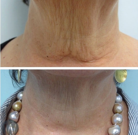 INFINI Neck Tightening Before and After