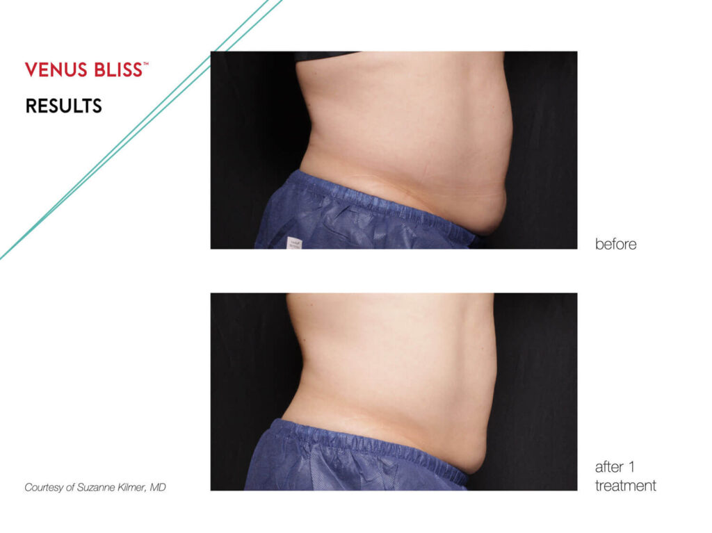 The Venus Legacy™ is your best option for combating stubborn fat areas and cellulite.