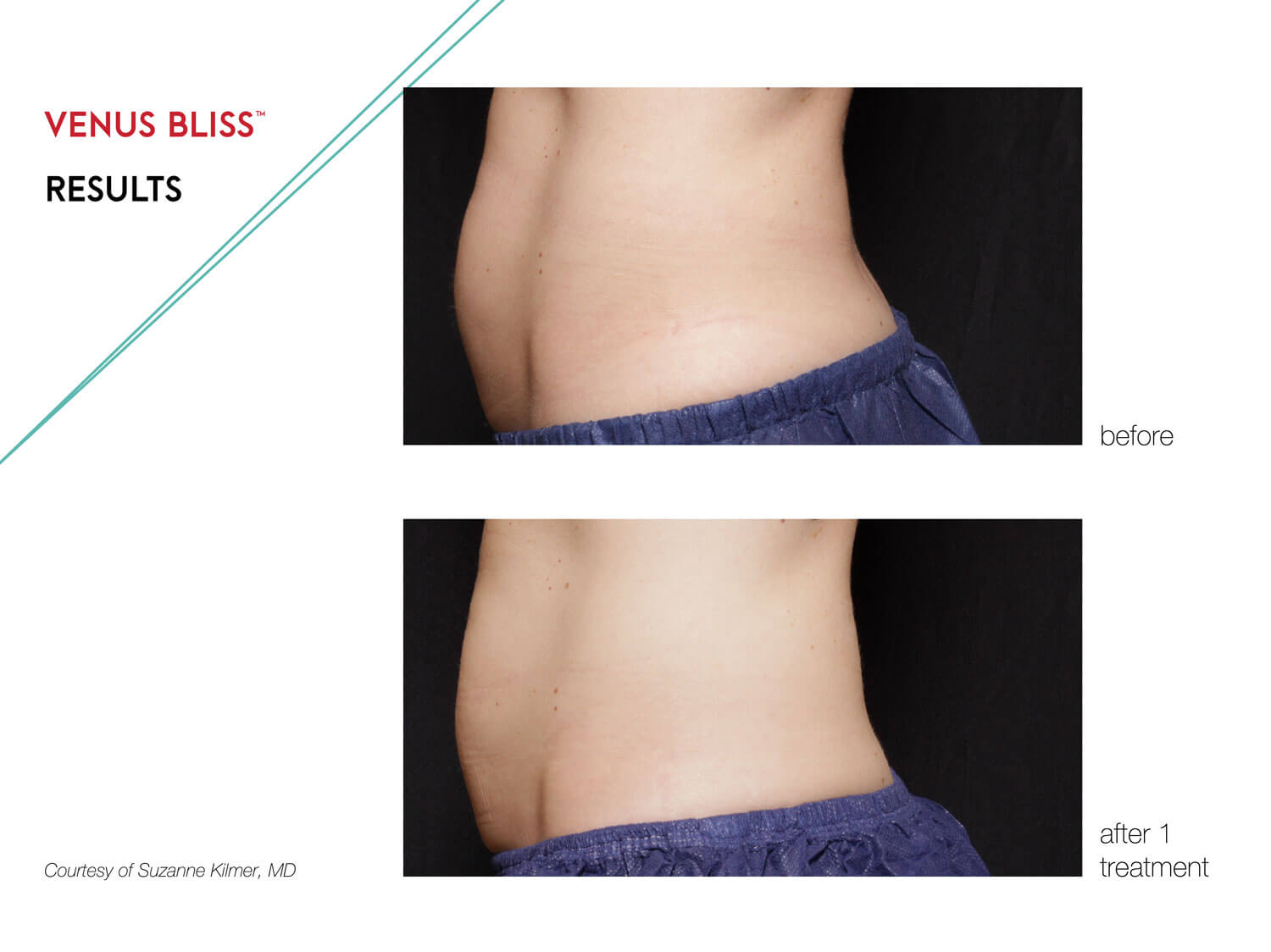 The Venus Legacy™ is your best option for combating stubborn fat areas and cellulite.