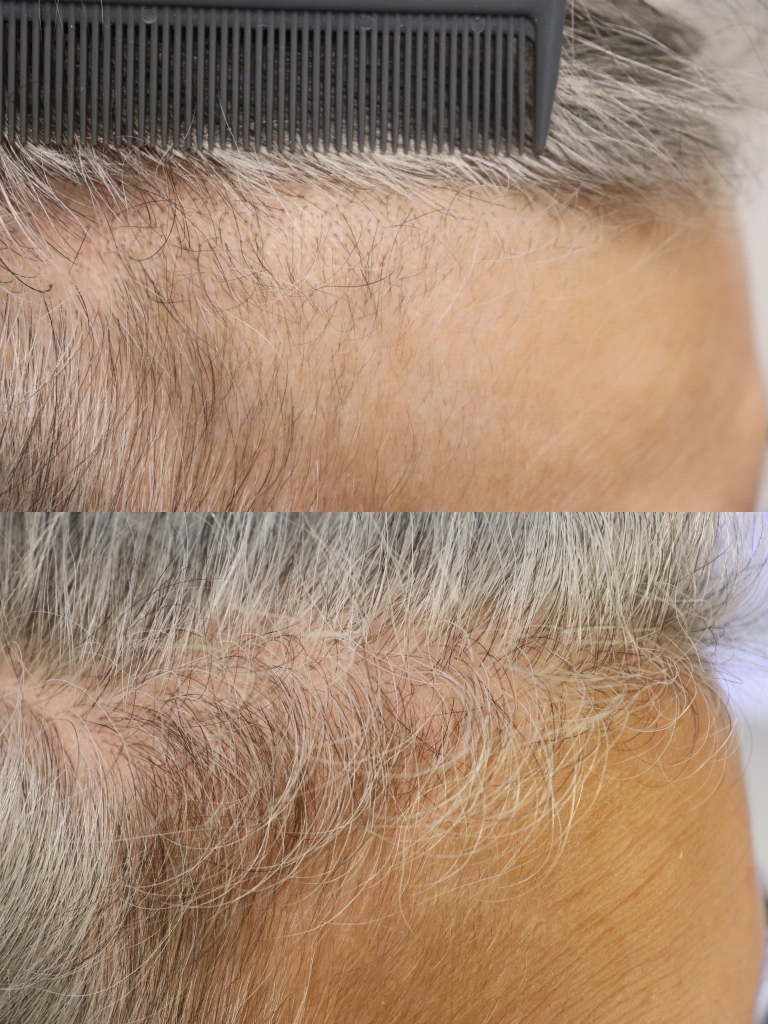 Hair Enhancement & Restoration - Before and After