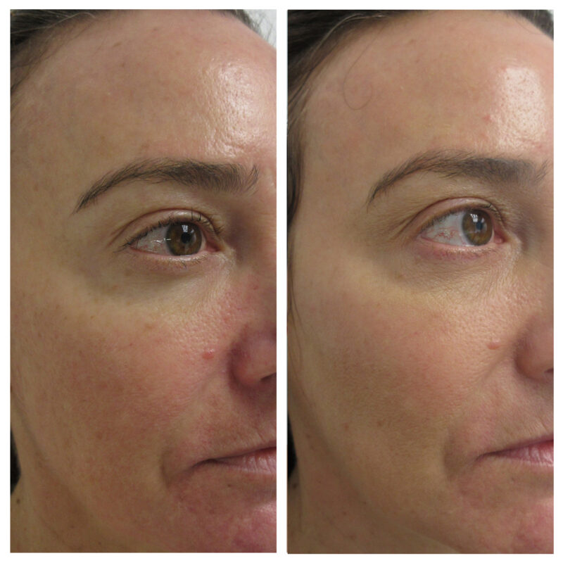 Lutronic® LaseMD UltraTM Fractional Laser Resurfacing - Before and After