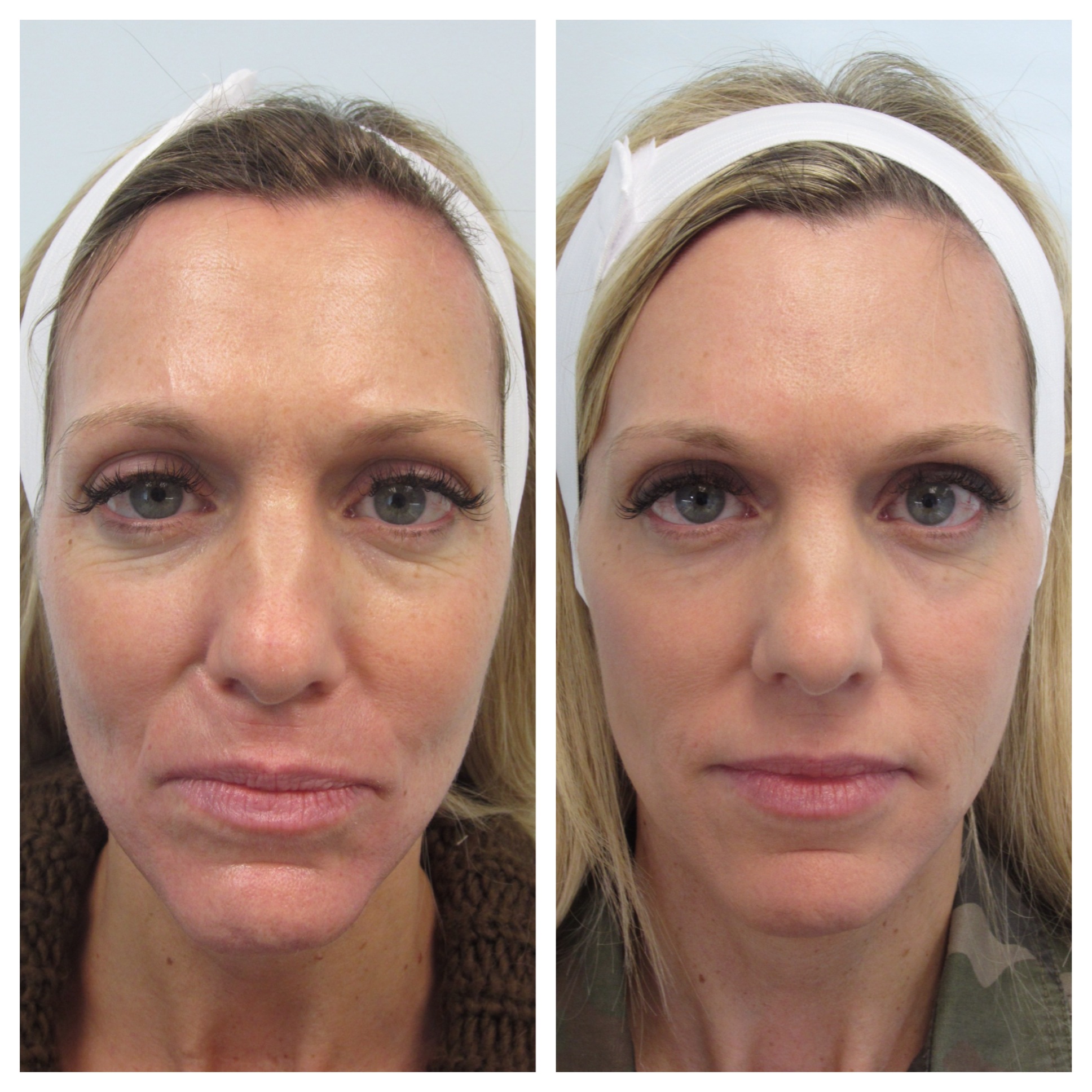 Advanced Facial Contouring - Before and After