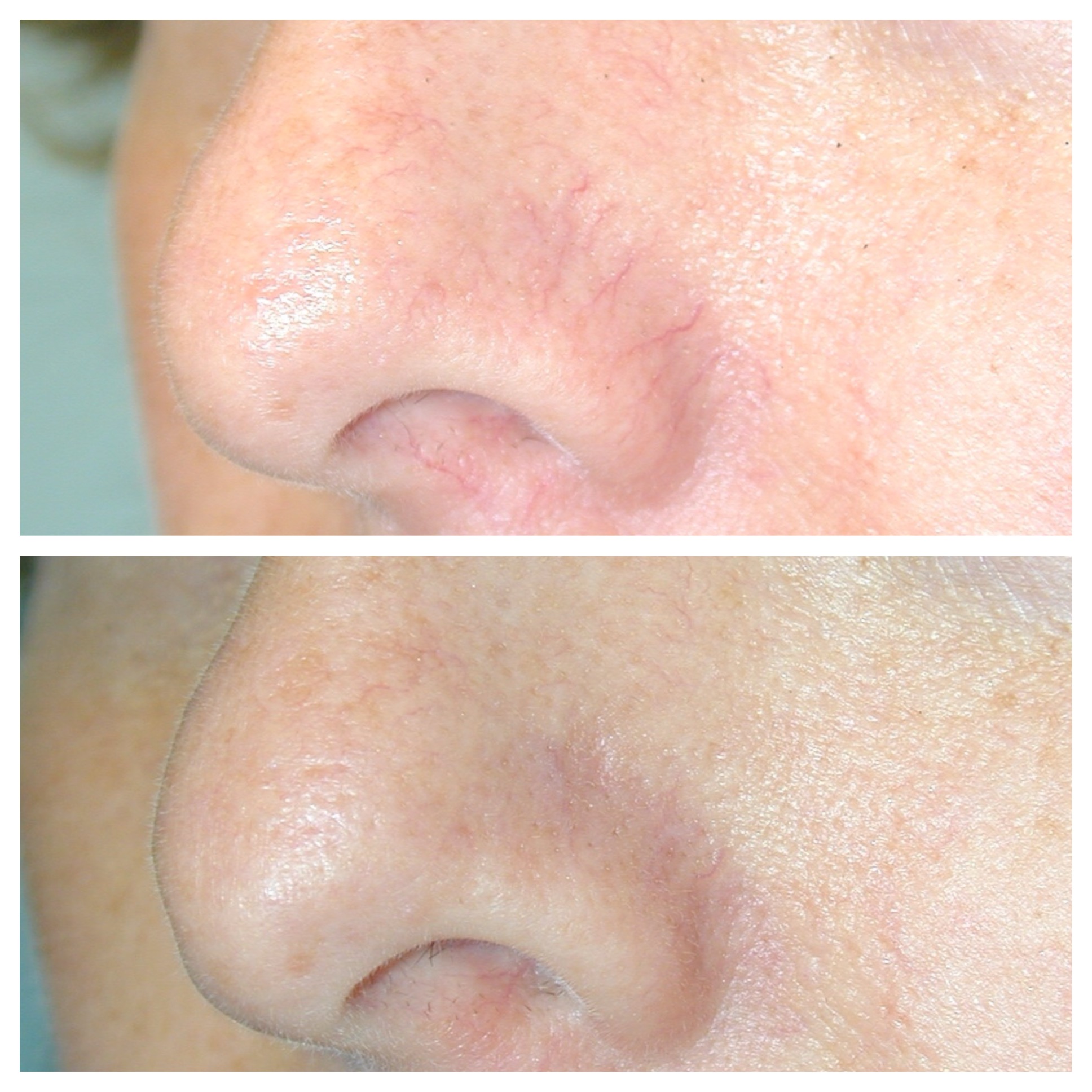 DermaV laser - Before & After photos