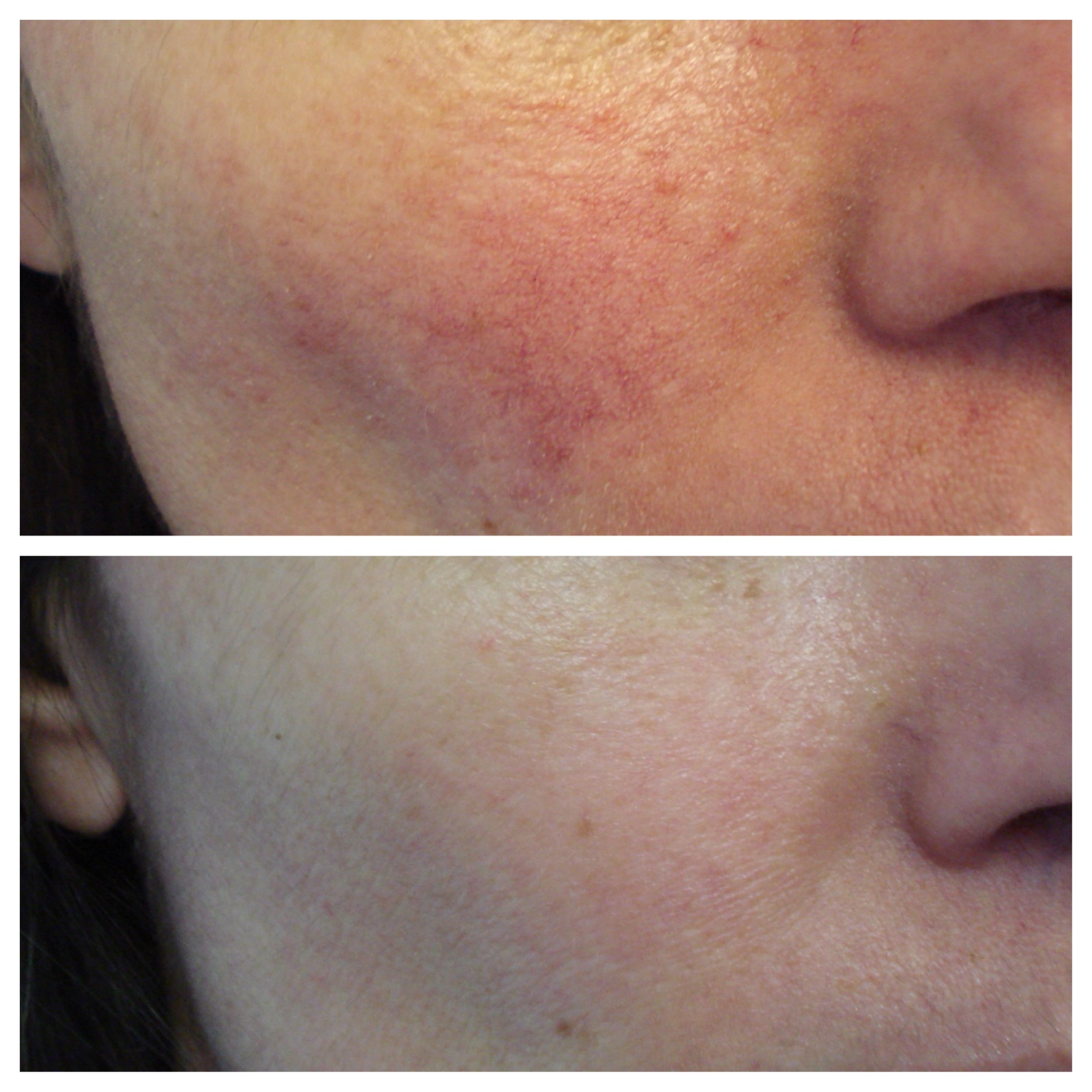 DermaV laser - Before & After photos