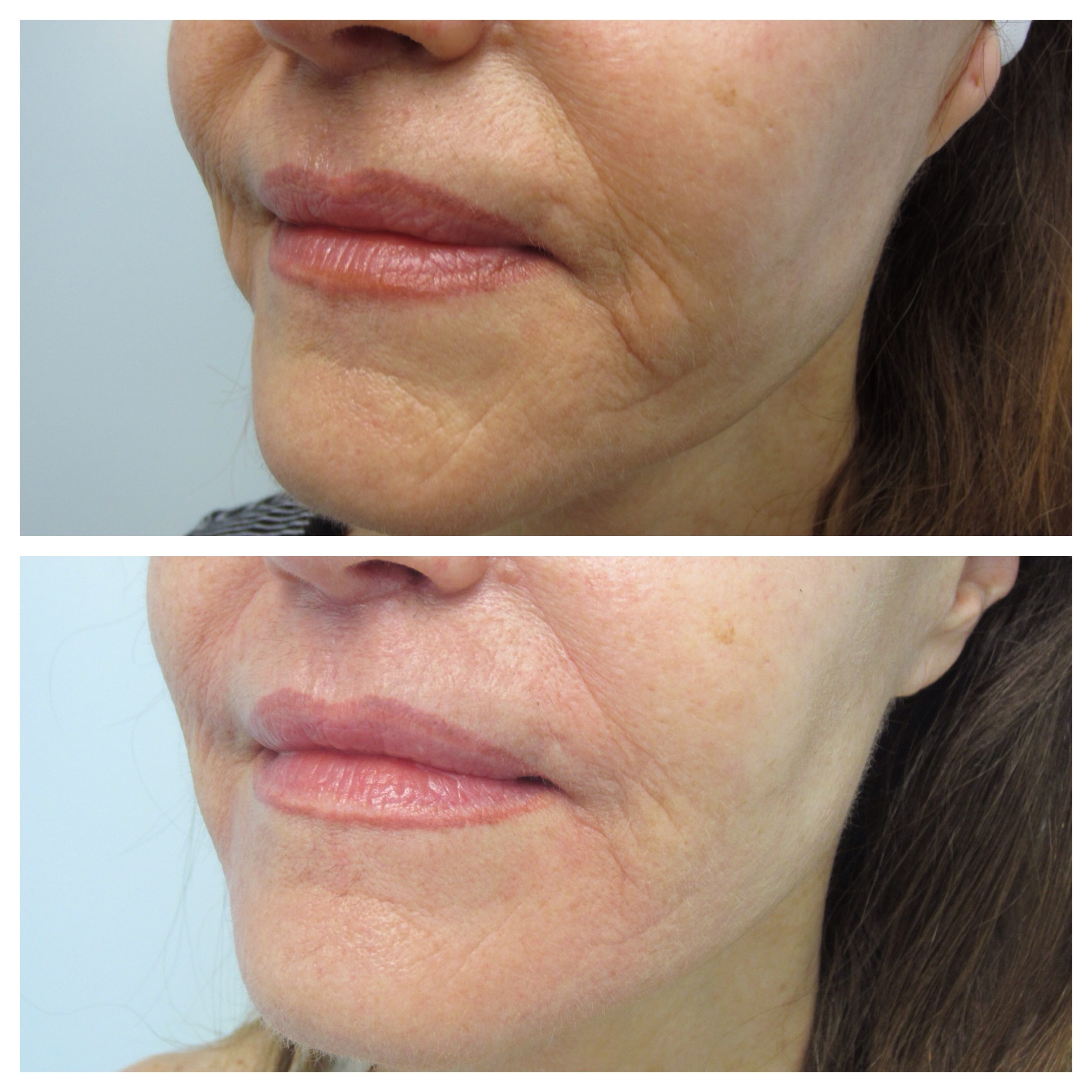 Lutronic® Radiofrequency Microneedling - Before and After