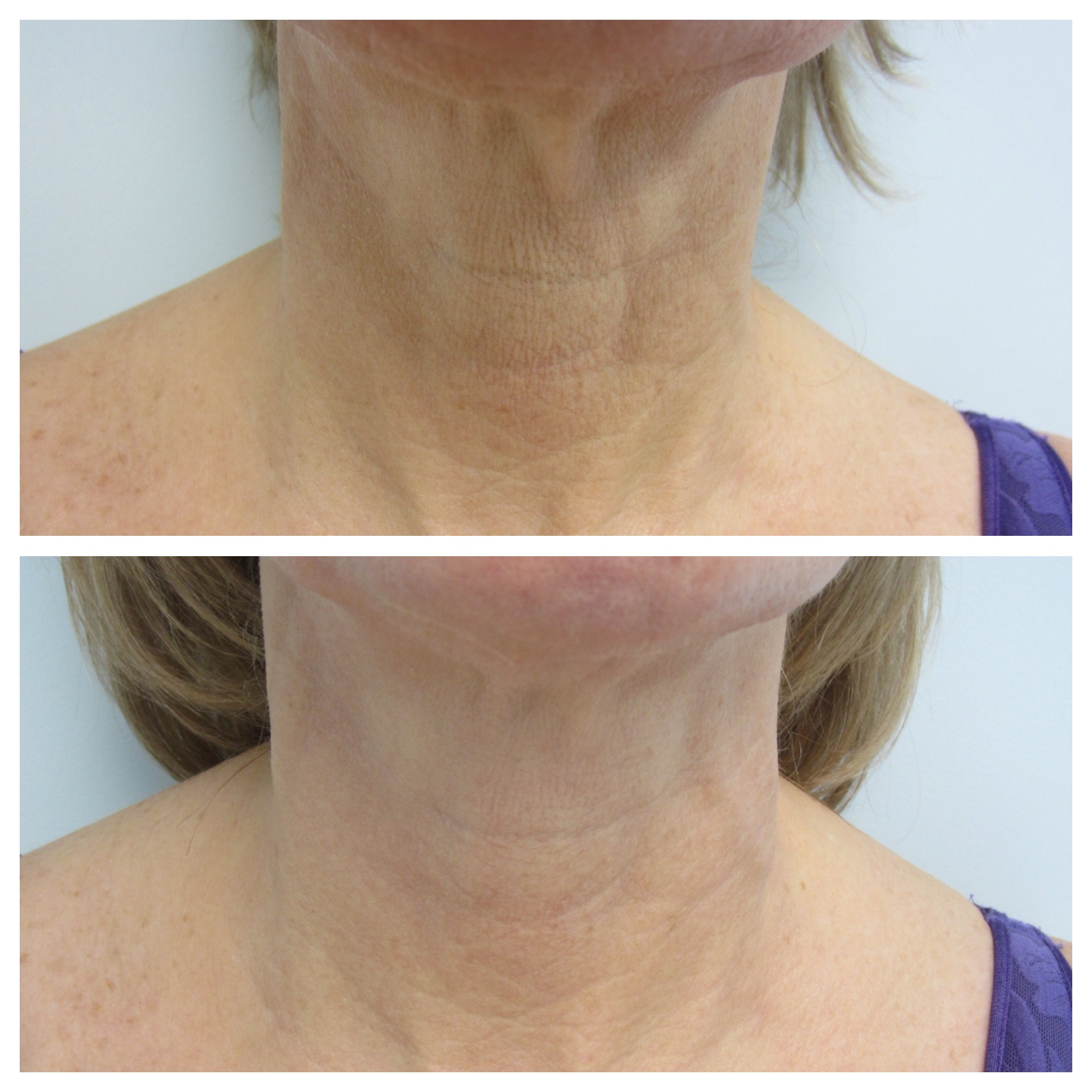 Lutronic® Radiofrequency Microneedling - Before and After