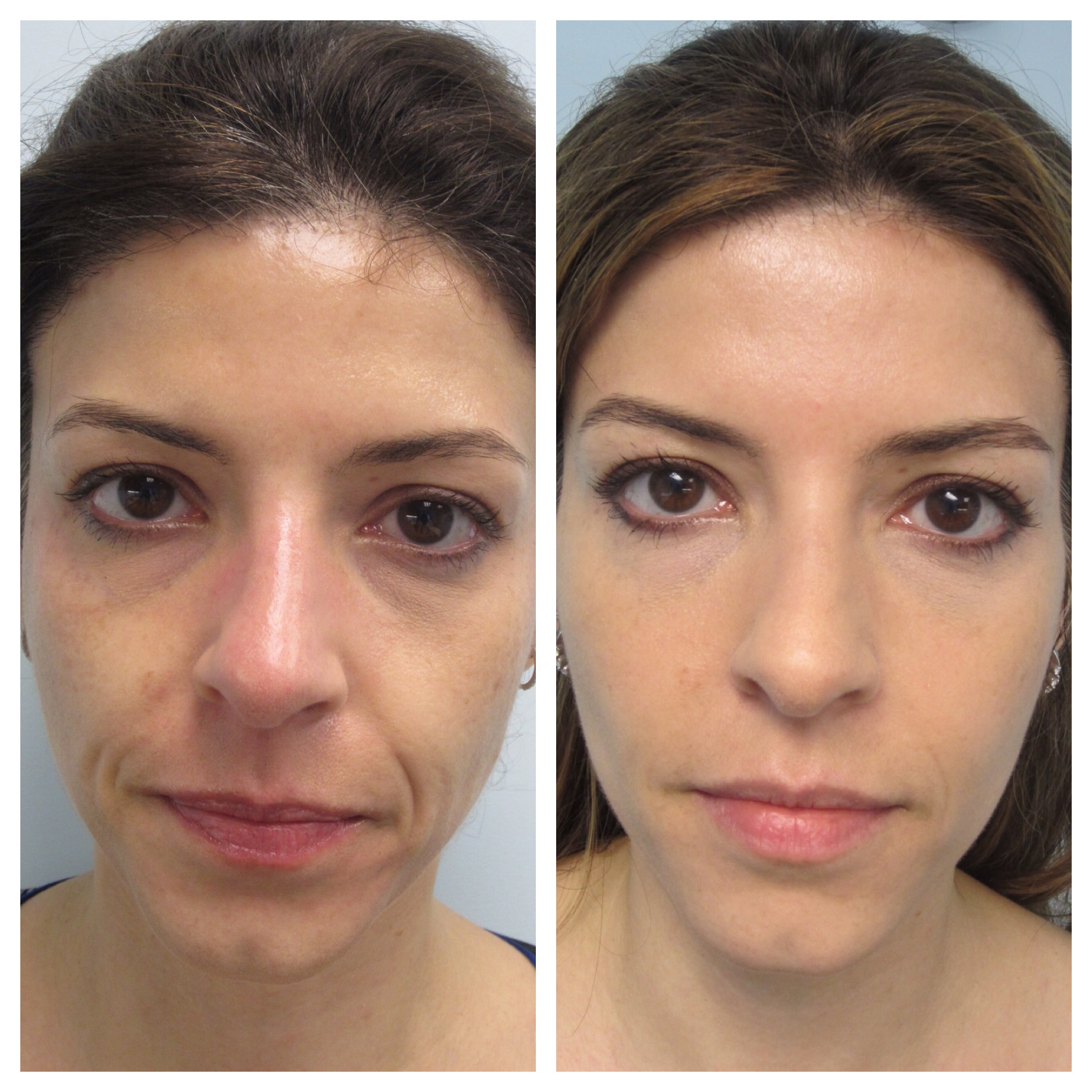 Advanced Facial Contouring - Before and After