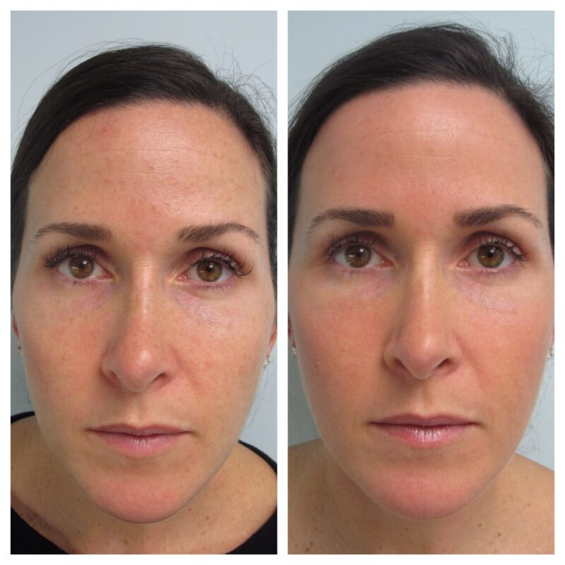 Lutronic® LaseMD UltraTM Fractional Laser Resurfacing - Before and After