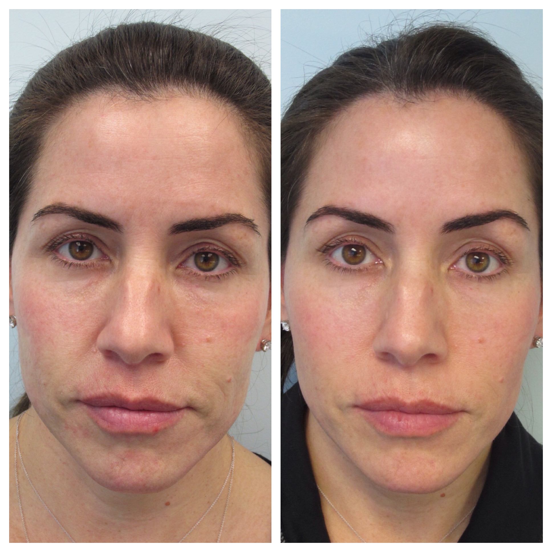 Advanced Facial Contouring - Before and After
