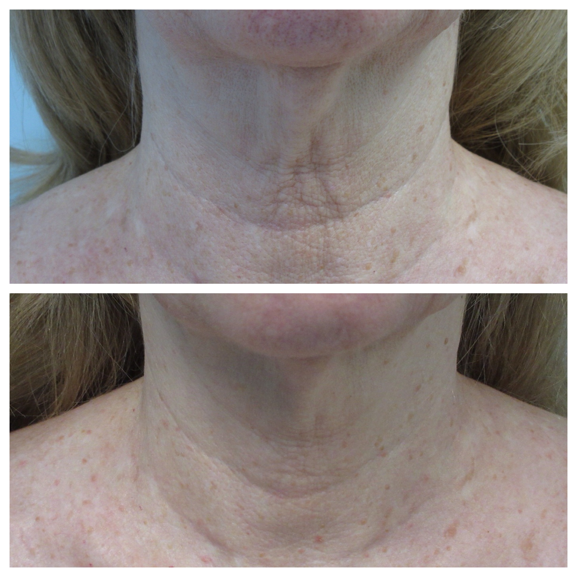 Lutronic® Radiofrequency Microneedling - Before and After