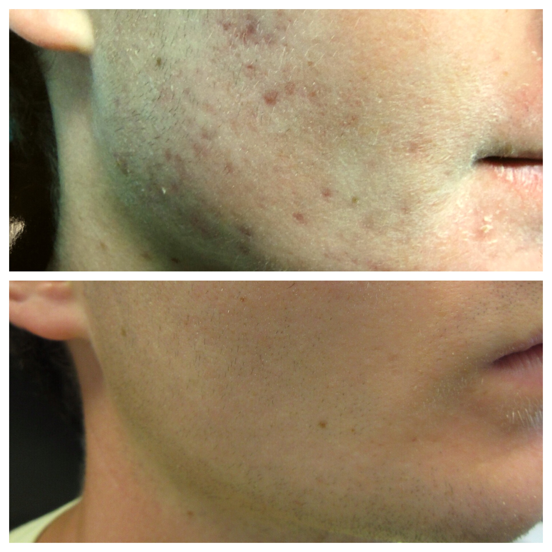 DermaV laser - Before & After photos