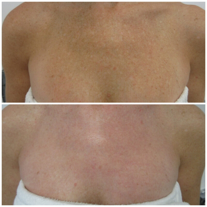 Lutronic® LaseMD UltraTM Fractional Laser Resurfacing - Before and After