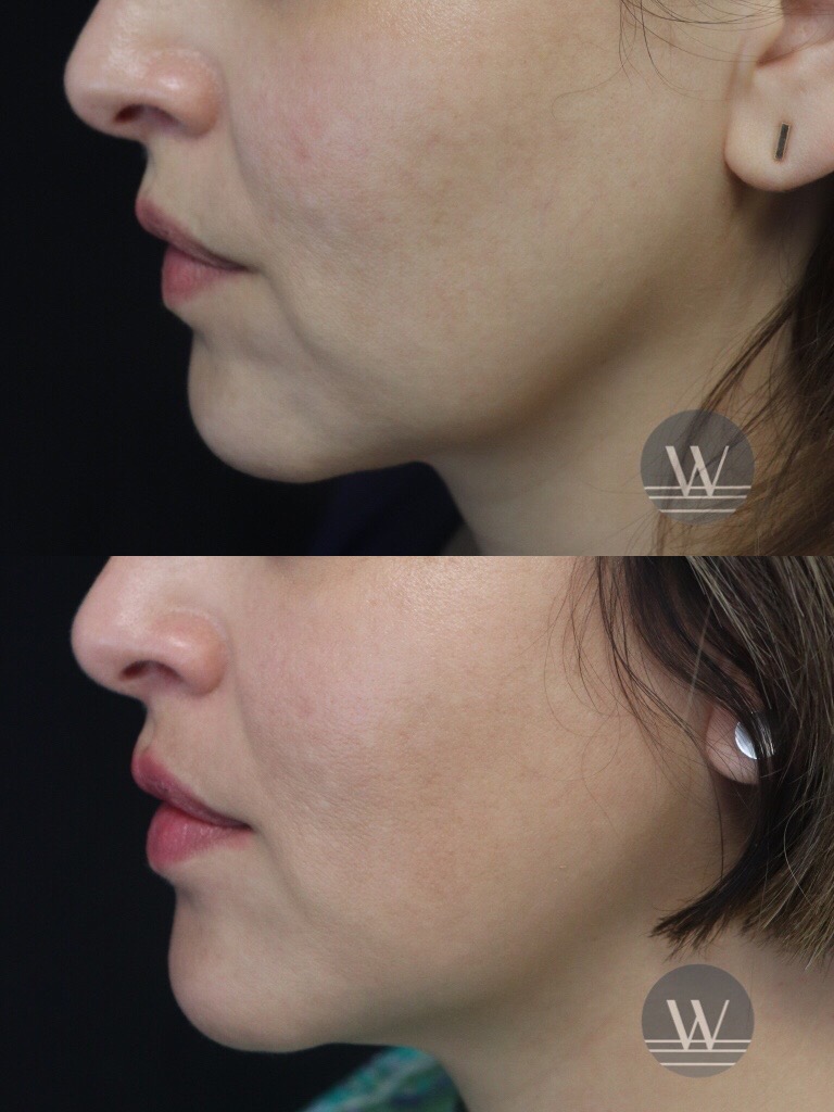 Advanced Facial Contouring - Before and After