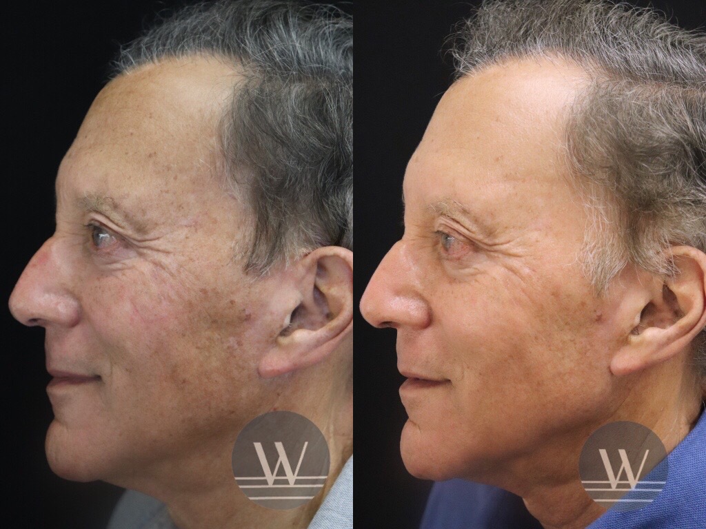 Lutronic® LaseMD UltraTM Fractional Laser Resurfacing - Before and After