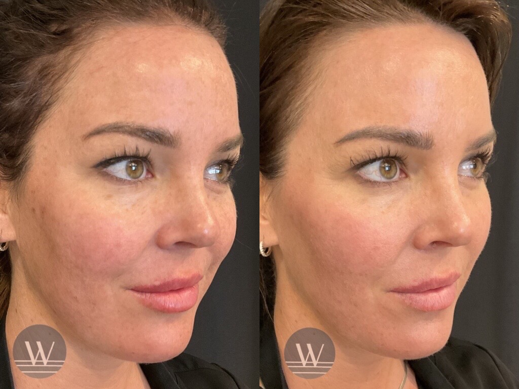Lutronic® LaseMD UltraTM Fractional Laser Resurfacing - Before and After