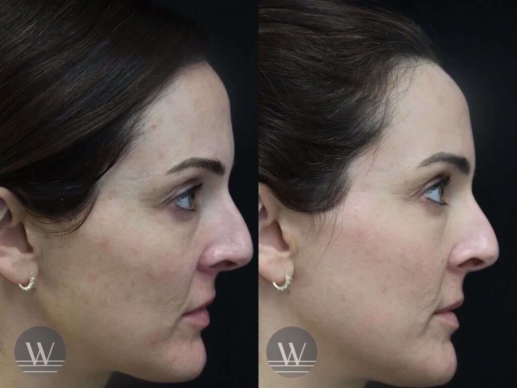 Lutronic® LaseMD UltraTM Fractional Laser Resurfacing - Before and After